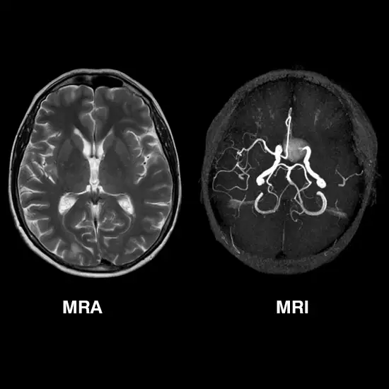MRI and MRA Of Brain